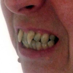 Δείτε την 49χρονη Βρετανίδα με δόντια βρυκόλακα! [photos]